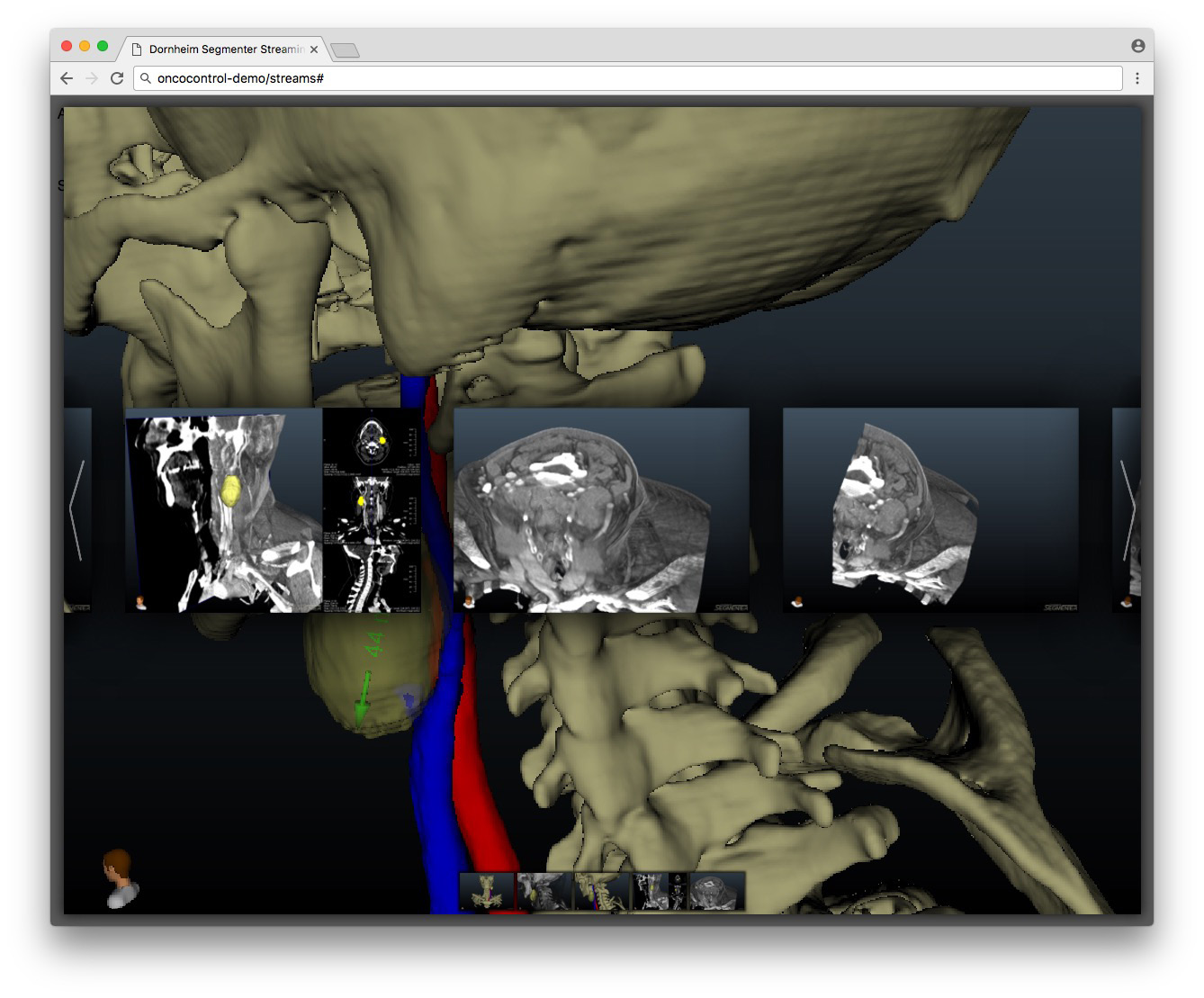 3D reconstruction of the head and neck region with overlaid CT slices in the web browser