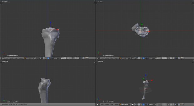Prototype positioning of a knee implant on the 3D bone model