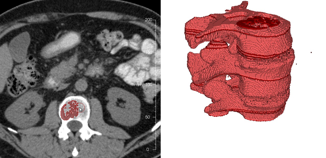 Dornheim Segmenter – segmentation of DICOM data and 3D model generation